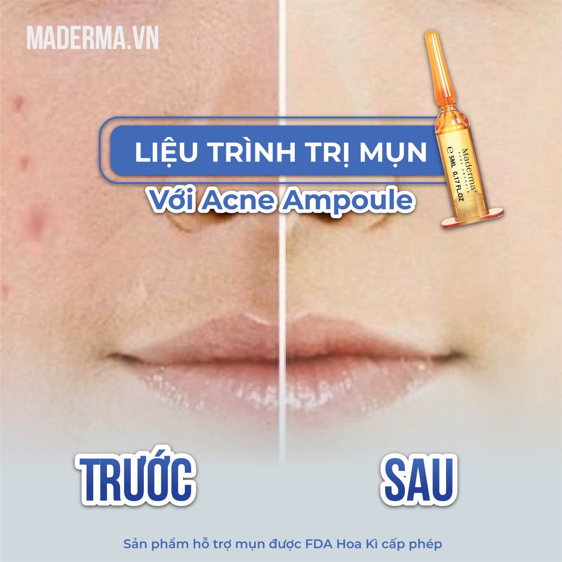 tinh-chat-mun-maderma-2